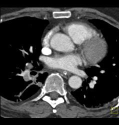 Saddle Emboli - CTisus CT Scan