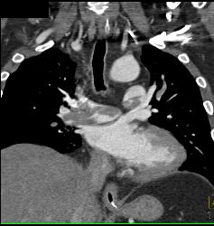 Saddle Emboli - CTisus CT Scan