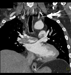 Saddle Emboli - CTisus CT Scan