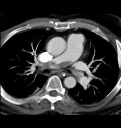 Saddle Emboli - CTisus CT Scan