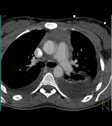 Pseudo Dissection of the Ascending Aorta. See the Full Sequence of Images Including the Normal Study When Gated - CTisus CT Scan