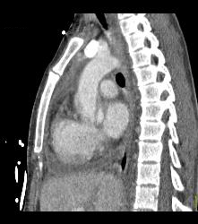 Pseudo Dissection of the Ascending Aorta. See the Full Sequence of Images Including the Normal Study When Gated - CTisus CT Scan