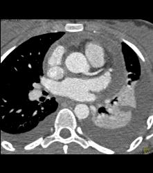 Pseudo Dissection of the Ascending Aorta. See the Full Sequence of Images Including the Normal Study When Gated - CTisus CT Scan