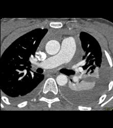 Pseudo Dissection of the Ascending Aorta. See the Full Sequence of Images Including the Normal Study When Gated - CTisus CT Scan