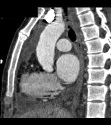 Pseudo Dissection of the Ascending Aorta. See the Full Sequence of Images Including the Normal Study When Gated - CTisus CT Scan