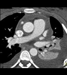 Pseudo Dissection of the Ascending Aorta. See the Full Sequence of Images Including the Normal Study When Gated - CTisus CT Scan