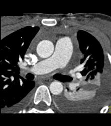 Pseudo Dissection of the Ascending Aorta. See the Full Sequence of Images Including the Normal Study When Gated - CTisus CT Scan