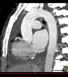 Pseudo Dissection of the Ascending Aorta. See the Full Sequence of Images Including the Normal Study When Gated - CTisus CT Scan