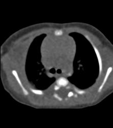 Prominent Thymus and No Evidence of Coa - CTisus CT Scan