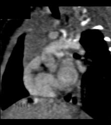 Prominent Thymus and No Evidence of Coa - CTisus CT Scan