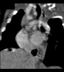 Prominent Thymus and No Evidence of Coa - CTisus CT Scan