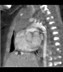 Prominent Thymus and No Evidence of Coa - CTisus CT Scan