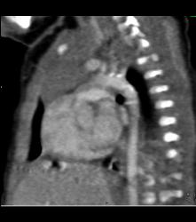 Prominent Thymus and No Evidence of Coa - CTisus CT Scan