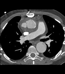 Pseudo-aneurysm Aortic Root - CTisus CT Scan