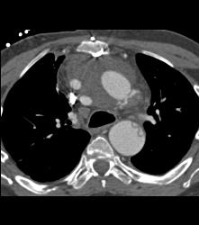 Pseudo-aneurysm Aortic Root - CTisus CT Scan