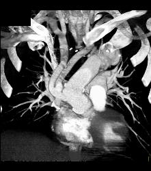 Pseudo-aneurysm Aortic Root - CTisus CT Scan