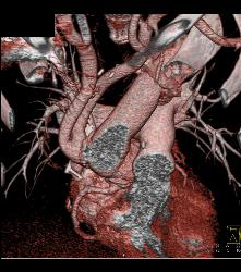 Pseudo-aneurysm Aortic Root - CTisus CT Scan