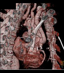 Pseudo-aneurysm Aortic Root - CTisus CT Scan