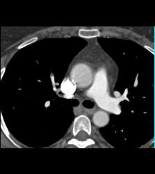 Pulmonary Embolism (PE) in Right Upper Lobe - CTisus CT Scan