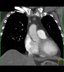 Pulmonary Embolism (PE) in Right Upper Lobe - CTisus CT Scan