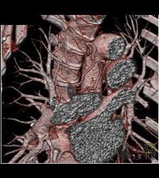 Dilated Bronchial Arteries - CTisus CT Scan