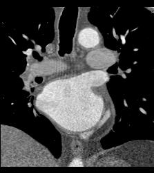 Normal Aortic Root and Valve But Incidental PE -right Main Pulmonary Artery- Seen on Cardiac CTA Study - CTisus CT Scan