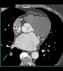 normal size of aortic root on ct