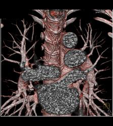 Dilated Bronchial Arteries - CTisus CT Scan