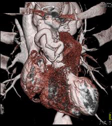 Reimplanted Right Coronary Artery - CTisus CT Scan