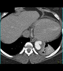 Ulceration in Descending Thoracic Aorta - CTisus CT Scan