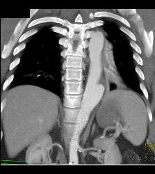 Ulceration in Descending Thoracic Aorta - CTisus CT Scan