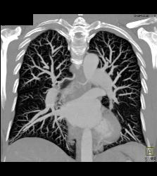 Dilated Bronchial Arteries - CTisus CT Scan