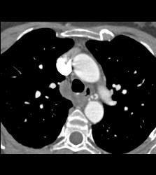 Dilated Bronchial Arteries - CTisus CT Scan