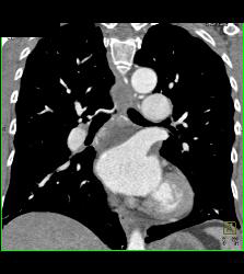 Dilated Bronchial Arteries - CTisus CT Scan