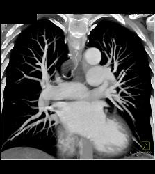 Dilated Bronchial Arteries - CTisus CT Scan