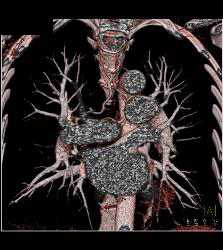 Dilated Bronchial Arteries - CTisus CT Scan