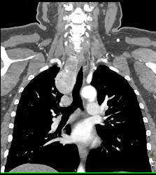 Goiter With Substernal Extension - CTisus CT Scan