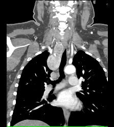 Goiter With Substernal Extension - CTisus CT Scan