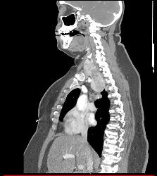 Goiter With Substernal Extension - CTisus CT Scan