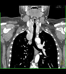 Goiter With Substernal Extension - CTisus CT Scan