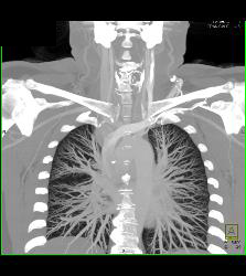 Goiter With Substernal Extension - CTisus CT Scan