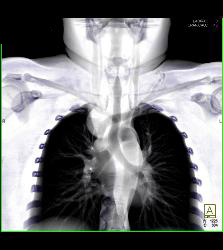 Goiter With Substernal Extension - CTisus CT Scan