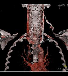 Goiter With Substernal Extension - CTisus CT Scan