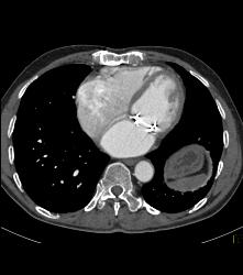 Dilated Left Atrium - CTisus CT Scan