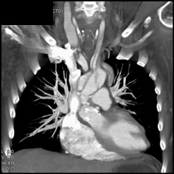 Dissection Extends Into Left Carotid Artery - CTisus CT Scan