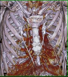 Aneurysm At Site of Reimplanted Right Right Coronary Artery - CTisus CT Scan