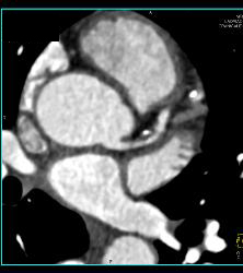 CCTA With Left Anterior Descending Coronary Artery (LAD) Plaque Without Critical Stenosis - CTisus CT Scan