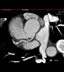 CCTA With Left Anterior Descending Coronary Artery (LAD) Plaque Without Critical Stenosis - CTisus CT Scan