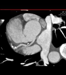 CCTA With Left Anterior Descending Coronary Artery (LAD) Plaque Without Critical Stenosis - CTisus CT Scan