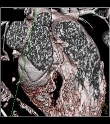 CCTA With Left Anterior Descending Coronary Artery (LAD) Plaque Without Critical Stenosis - CTisus CT Scan